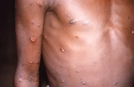 Mpox: conheça sintomas, transmissão, prevenção e tudo o que se sabe sobre a doença até agora